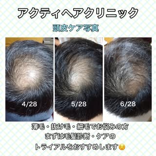 経過写真📷

こんにちは！
アクティヘアクリニック安城店です♪

本日は頭皮ケアのお客様の経過写真のご紹介です！

アクティでは週1回のサロンケアとご自宅でケア商品を使用して頂き頭皮環境を整え髪の毛