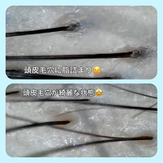 頭皮毛穴‼️

こんにちは！
アクティヘアクリニック安城店です♪

↓↓当てはまりませんか？

頭皮が脂っぽい
ベタつく
頭皮の臭い
脂質を多く摂取している
洗髪は1日おき

頭皮毛穴は詰まることで
