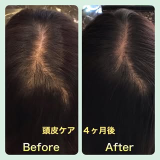 ✨Before After ✨

こんにちは☀️
アクティヘアクリニックです♪

本日は頭皮ケアを4ヶ月されたお客様のお写真です！

50代前半女性のお客様
頭頂部を気にされてのご来店

週1回のサロ