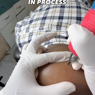 🎯 The Process Behind the Transformation

Scalp Micropigmentation is not just about creating dots—it