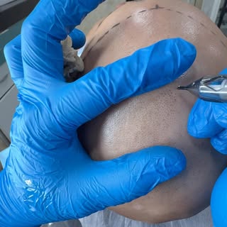 Why Choose Scalpdots?

✔ Specialized SMP Expertise
Scalp Micropigmentation isn’t just one of our ser