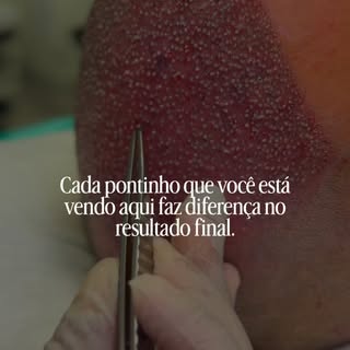 No transplante capilar, não se trata apenas de implantar fios. 

Cada enxerto é posicionado de forma