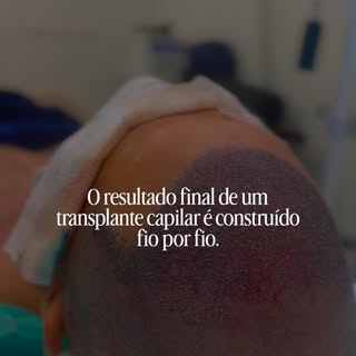O resultado final de um transplante capilar é construído fio por fio.

Após o procedimento, cada fas