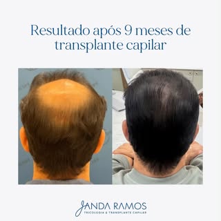 9 meses após o transplante capilar… e esse é o resultado! ✨

Cada novo fio representa uma transforma