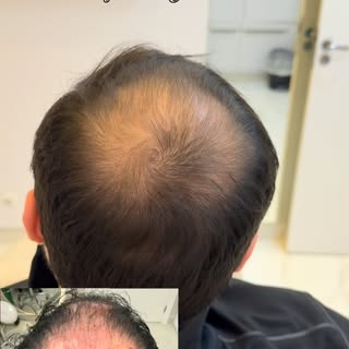 5 meses de tratamento clínico! 

#tricologia #alopeciaandrogenetica