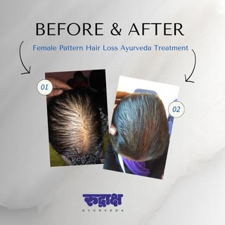 Female pattern baldness, also known as androgenetic alopecia, is a common condition where women expe
