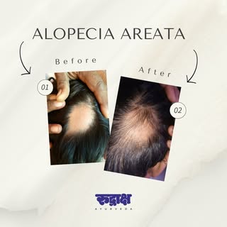 A young male patient had a significant round patch of alopecia areata and sought help from Dr. Kiran