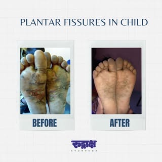 Plantar fissures, or cracks in the skin of the feet, can be uncomfortable, especially in children. A