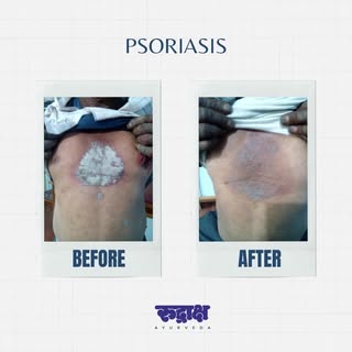 Result is our identity in Psoriasis Ayurveda Treatment 

Rudraksha Ayurveda offers a comprehensive a