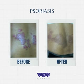 Result is our identity in Psoriasis Ayurveda Treatment

Rudraksha Ayurveda offers a comprehensive an