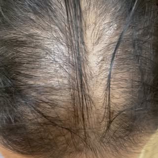 Female pattern hair loss,also known as androgenetic alopecia, is indeed a growing concern due to var