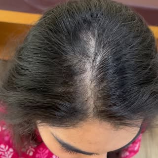 Female pattern hair loss,also known as androgenetic alopecia, is indeed a growing concern due to var