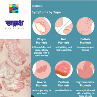 Psoriasis AyurvedavTreatment by Dr. Kiran Chaudhari – Best Ayurveda Dermatologist in Sargasan, Gandh