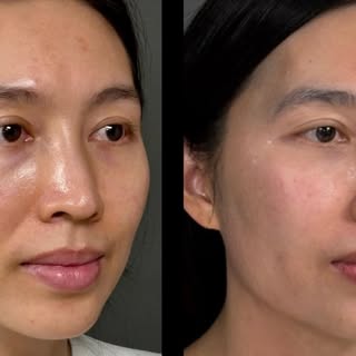 Thoughtful facial rejuvenation with lower lid blepharoplasty and precision fat transfer. The goal is