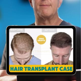 In your 30s, a receding hairline isn’t just about hair. It’s about watching something change on your