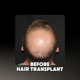 You probably remember James - our patient who brought us along for every step of his hair transplant