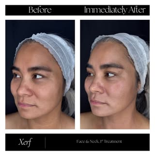 The immediate lift is just your first glimpse ✨

These before & after photos were taken the same day