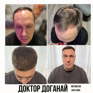 ТАК ДЕЛАЮТ ПРОФЕССИОНАЛЬНЫЙ DHI 

ТОЛЬКО В КЛИНИКЕ ДОКТОРА ДОГАНАЙ ВЫ СМОЖЕТЕ ПОЛУЧИТЬ ТАКОЙ РЕЗУЛЬТ