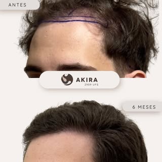 ✨ Reconstrucción frontal | 6 meses de evolución ✨

Cada caso es único, y este es un claro ejemplo de