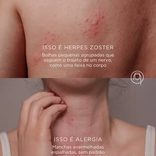 O herpes zoster é um dos diagnósticos mais atrasados que vejo na medicina. 🚨
Não por falta de sinto