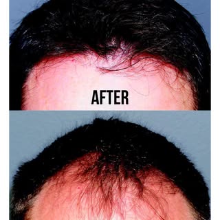 Before and After with #ARTAS #robotic #hairrestoration in #beverlyhills #losangeles #socal ☎️310-975