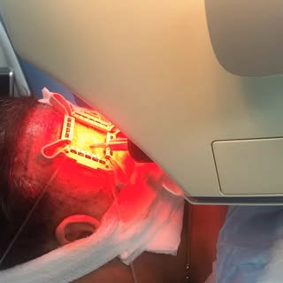 #robotic #hairrestoration with the #artas system in #beverlyhills . No linear scar. Quick recovery. 
