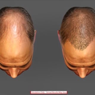 With #ARTAS #hairstudio we can design your hair restoration and demonstrate your results.  Consults 