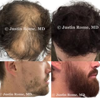 Need more hair or more beard? We’ve got you covered! #punintended #hairrestoration #hairtransplant #