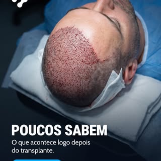Essa foto foi tirada no meio de uma cirurgia. Cada pontinho que você vê é um folículo sendo implanta