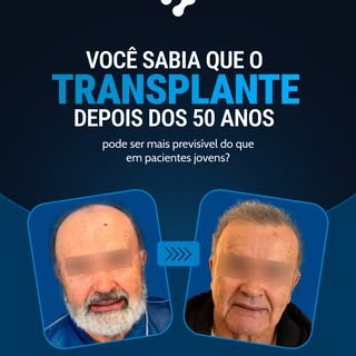 A calvície estabilizada é, na verdade, uma vantagem na hora do transplante.

Pode parecer contra-int