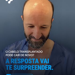 O cabelo transplantado pode cair de novo? A resposta vai te surpreender.

A resposta curta: não. E a
