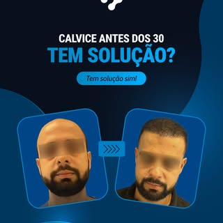 27 anos. Primeiras entradas. Área doadora preservada.

Esse foi o momento ideal para agir e o result