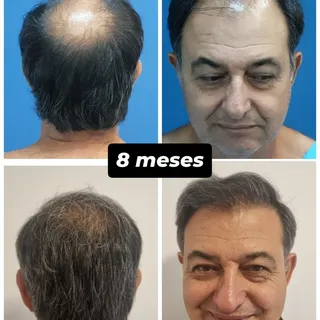 Hoje tivemos retorno do paciente Urbino.
Está com 8 meses de pós operatório e já com esse resultado 