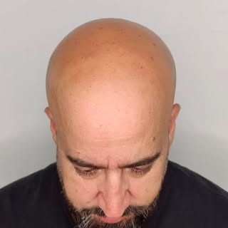 Os dejo otro ejemplo de micropigmentación capilar gracias a la generosidad de mi cliente por permiti