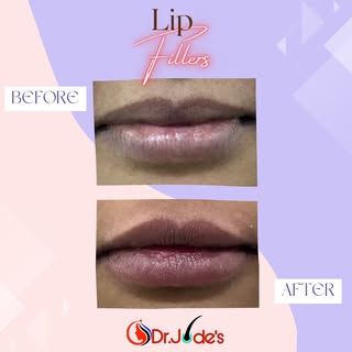👄Instant, safe and natural results
.
💫A subtle change goes a long way with lip fillers
.
🤩Get you