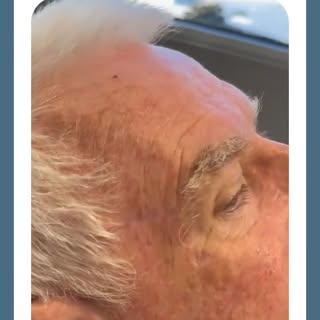 Healing after Mohs surgery is a process, and with precise technique and thoughtful reconstruction, r