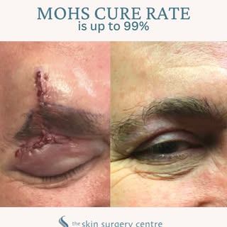 Mohs surgery offers up to a 99% cure rate for certain skin cancers with precision that preserves as 