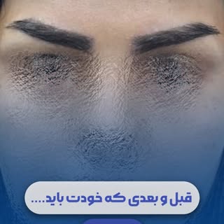 ⁨	⁨	باور می‌کنید این ابروها کاشته شده؟ 🤍✨

وقتی طراحی اصولی و اجرای دقیق کنار هم قرار بگیرن
نتیجه م