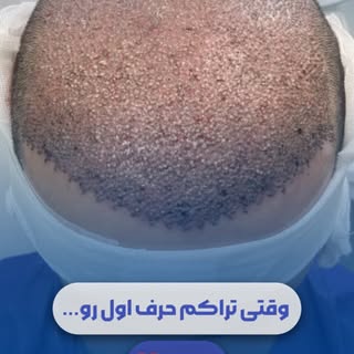 ⁨	با طاسی اومد و با یه کاشت فول تراکم برگشت!🤩

ما کاشت رو جوری انجام دادیم که حتی جای سوزن انداختن 