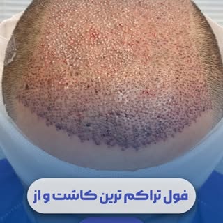 ⁨	وقتی تراکم و طراحی درست کنار هم قرار می‌گیرن✔️😁

از کم‌پشتی تا ظاهری پرتر و متراکم‌تر👌🏻
با طراح