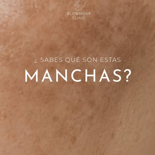Esas manchas tienen nombre.
Se llama melasma. Una hiperpigmentación crónica que afecta a millones de