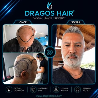 💫Değişimi bizimle yaşayın💫
Modern teknoloji ve deneyimli ekibimizle doğal ve estetik görünüme ulaş