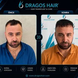 💫Değişimi bizimle yaşayın💫
Modern teknoloji ve deneyimli ekibimizle doğal ve estetik görünüme ulaş