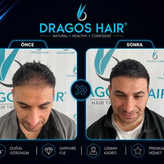💫Değişimi bizimle yaşayın💫
Modern teknoloji ve deneyimli ekibimizle doğal ve estetik görünüme ulaş