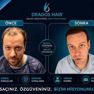 💫Değişimi bizimle yaşayın💫
Modern teknoloji ve deneyimli ekibimizle doğal ve estetik görünüme ulaş
