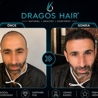 Gerçek sonuçlar, doğal görünüm. ✨
Her saç ekimi kişiye özel planlanır ve doğal saç çizgisi hedefleni