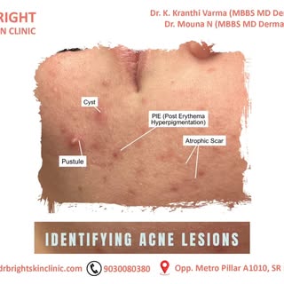 Acne is a very common skin condition that causes pimples. You’ll usually get pimples on your face. C