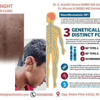 #neurofibromatosis
