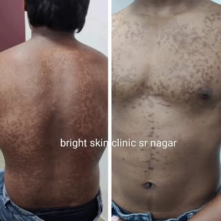 pityriasis versicolor

A common fungal infection that causes small, discoloured patches of skin.

Pi