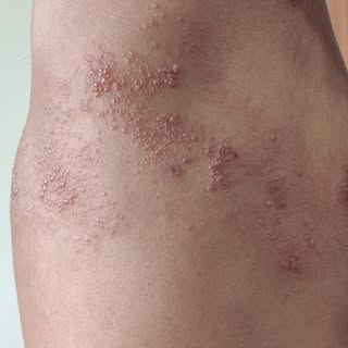 Herpes Zoster ( Shingles)
It is a localised, blistering and painful rash caused by reactivation of v